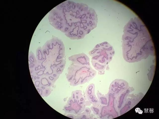 阴道鳞状上皮乳头状瘤？尖锐湿疣？（孔祥田老师病例分享，粉蓝医疗科技（杭州）有限公司女性生殖2群讨论，孔祥田(Max)*Roswell*老师讲解）