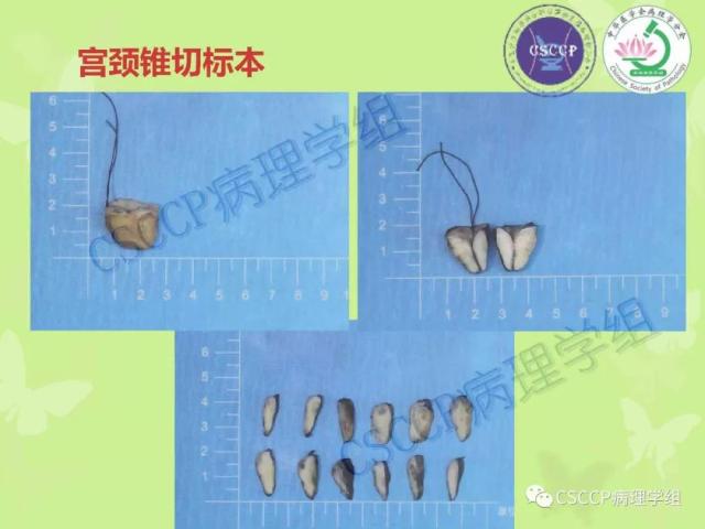 宫颈与子宫病变病理标本取材