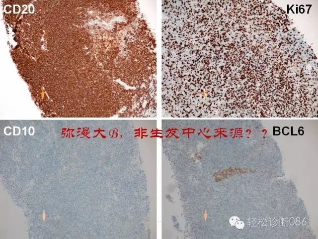 关于套细胞淋巴瘤的总结课件