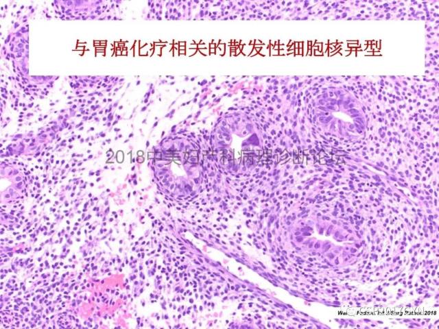 子宫内膜假肿瘤性病变及类似癌样病变