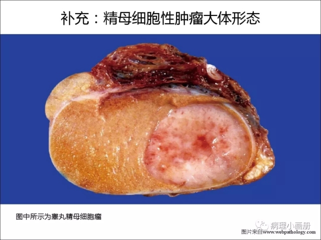 泌尿病理--精原细胞瘤VS精母细胞瘤