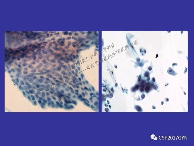 中华病理学会基层培训遵义站讲座（二）——宫颈细胞学诊断中陷阱与筛查进展