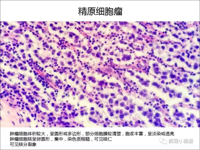 泌尿病理--精原细胞瘤VS精母细胞瘤