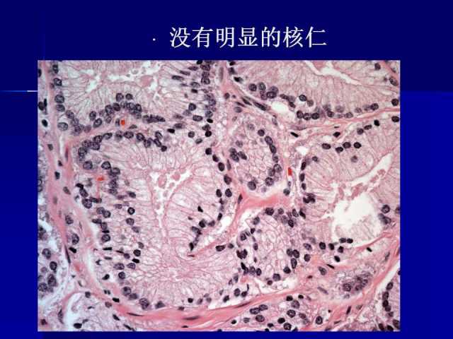前列腺病理诊断线索（上）——黄教悌