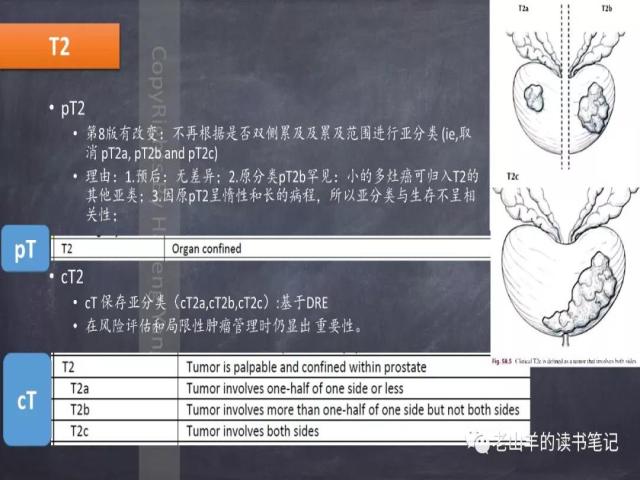 AJCC第8版 前列腺癌分期 之 病理学要点