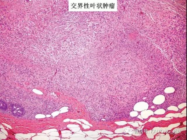 乳腺梭形细胞病变的病理诊断及进展（二）