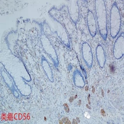 免疫组化结果的分析和常见问题的处理