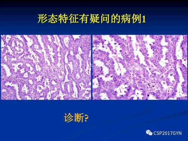 子宫内膜癌：诊断与进展