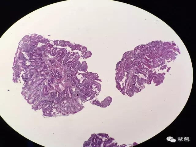 结、直肠管绒毛状腺瘤-高级别病变诊断等相关问题2（悄悄分享、孔祥田(Max)*Roswell*老师讲解）