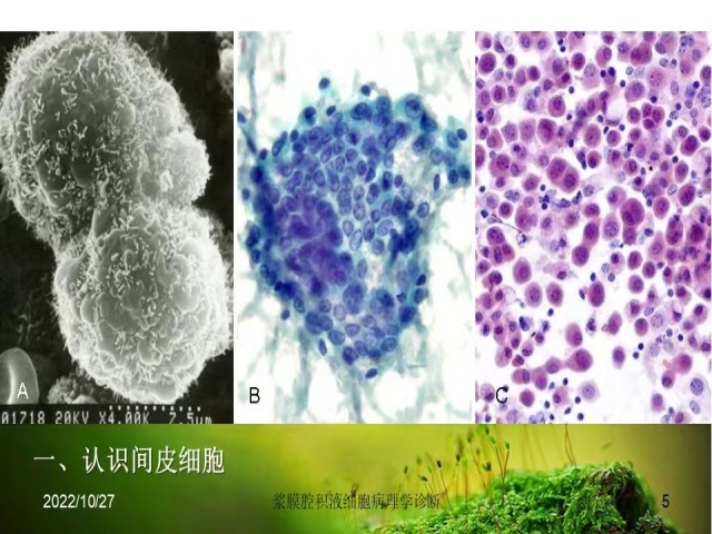 直播预告 | 今晚8点，马博文老师将为大家带来：《浆膜腔 积液细胞病理学诊断》，敬请期待！