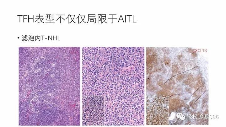 血管免疫母T细胞淋巴瘤