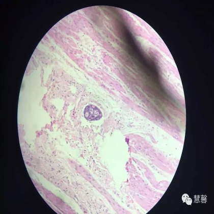 胃癌化疗后黏膜无癌、黏膜下广泛癌栓（慧馨分享，孔祥田(Max)*Roswell）