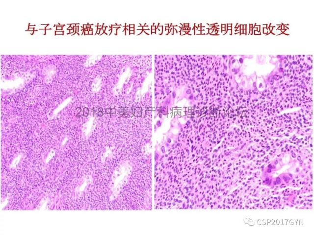 子宫内膜假肿瘤性病变及类似癌样病变