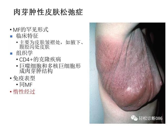 皮肤T细胞淋巴瘤