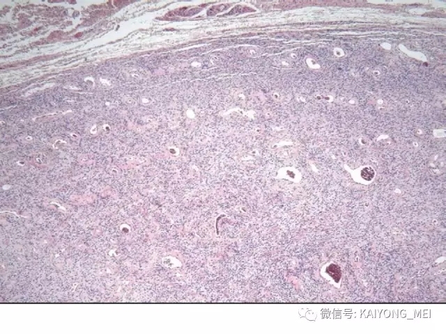 女性生殖道软组织肿瘤病理诊断及进展（一）