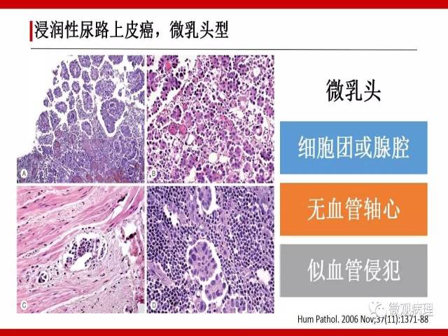 泌尿课程/浸润性尿路上皮癌病理学类型