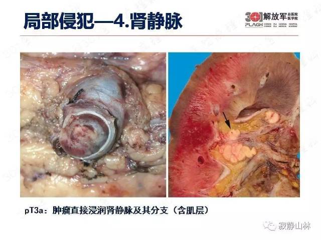 泌尿系统常见肿瘤标本病理报告规范