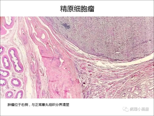 泌尿病理--精原细胞瘤VS精母细胞瘤