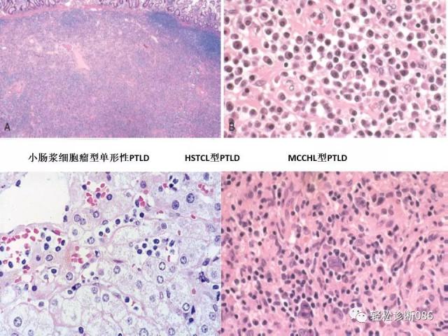 免疫缺陷相关淋巴组织增殖性疾病
