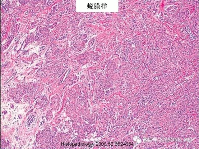 乳腺梭形细胞病变的病理诊断及进展（一）