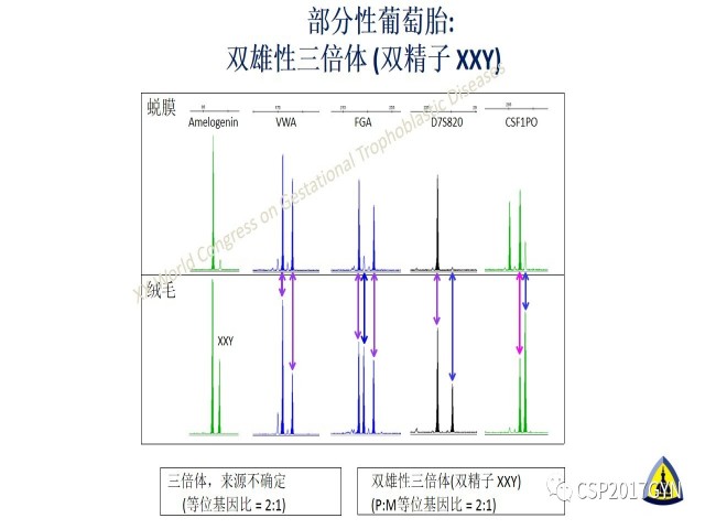 p57免疫组化染色及基因分型 在葡萄胎精确诊断中的应用