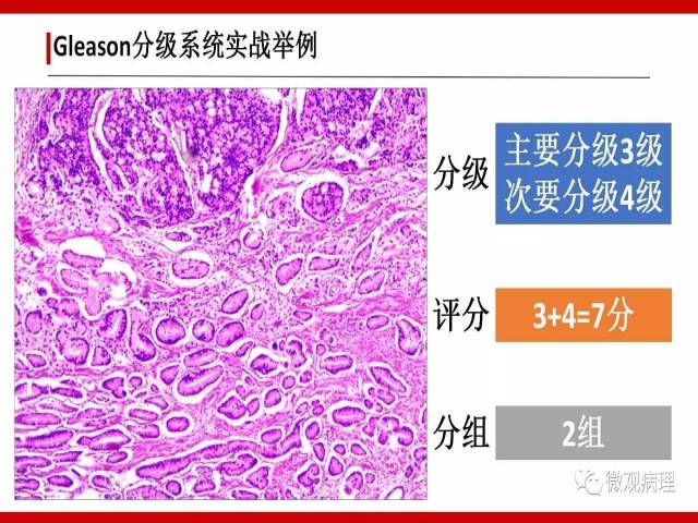 前列腺癌Gleason分级系统的前世今生
