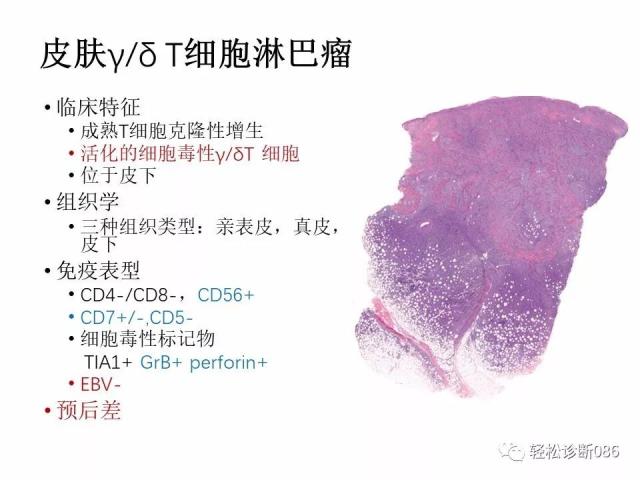 皮肤T细胞淋巴瘤