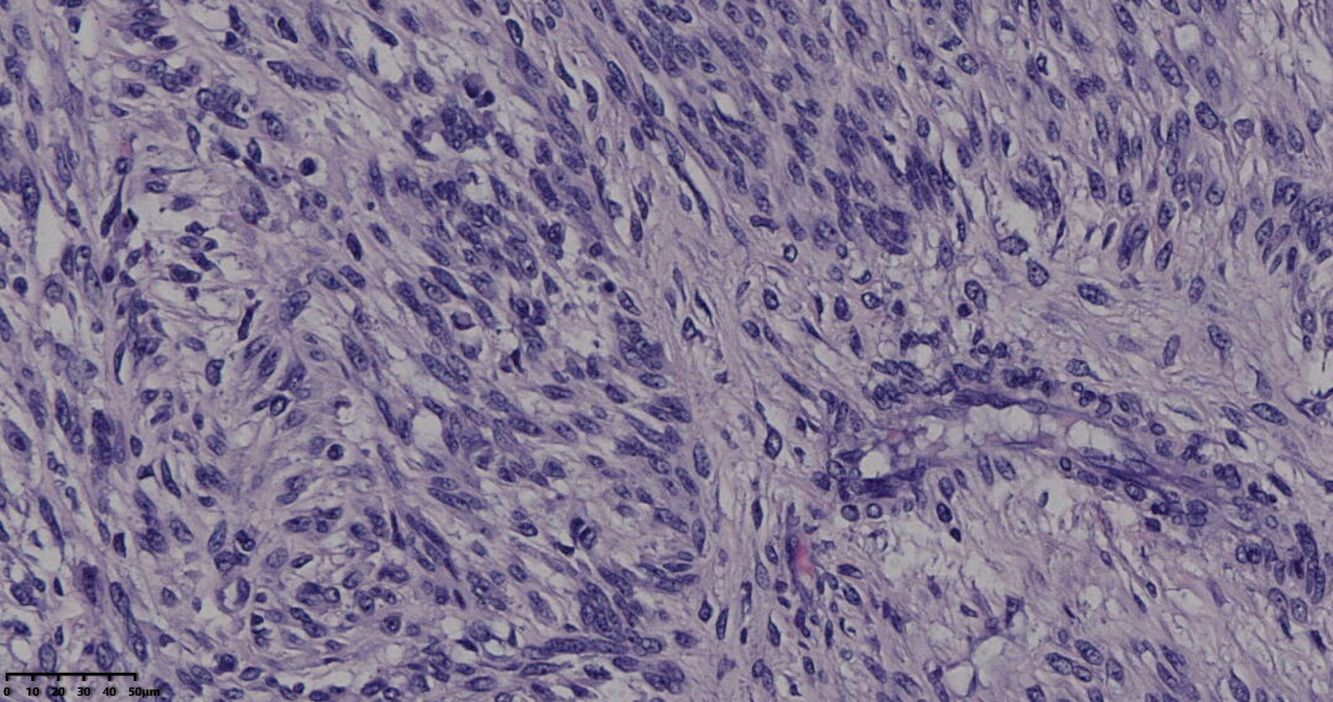 子宫多发性平滑肌瘤伴肉瘤