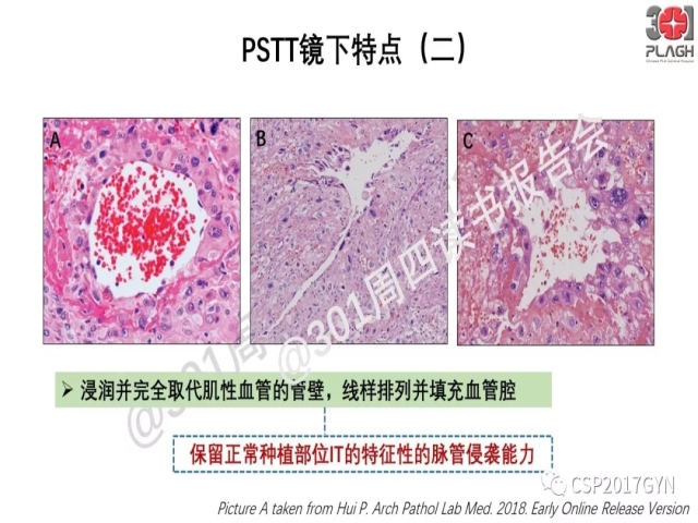 中间型滋养细胞肿瘤的诊断及鉴别诊断