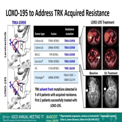 The efficacy of LOXO-101,a selective TRKI, in adult and pediatric TRK fusion cancers