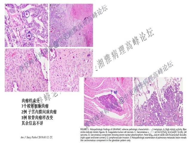 妇科肿瘤病理新进展——特殊类型的腺癌