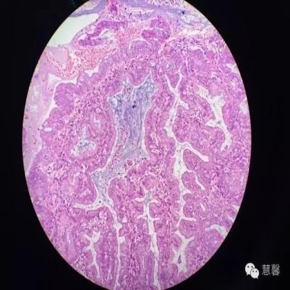 高分化子宫内膜样癌与分泌期子宫内膜、黏液腺癌的鉴别（孔令英分享，刘从容老师讲解）