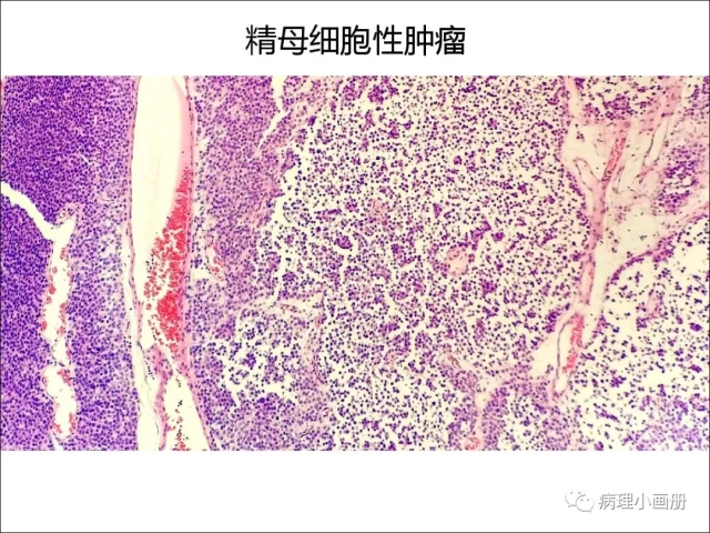 泌尿病理--精原细胞瘤VS精母细胞瘤