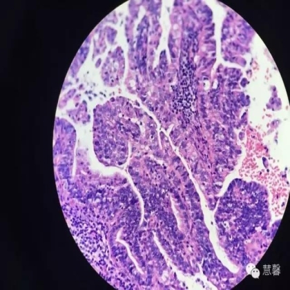 宫颈绒毛状腺癌诊断及相关问题（沈苗分享病例，刘从容老师讲解）