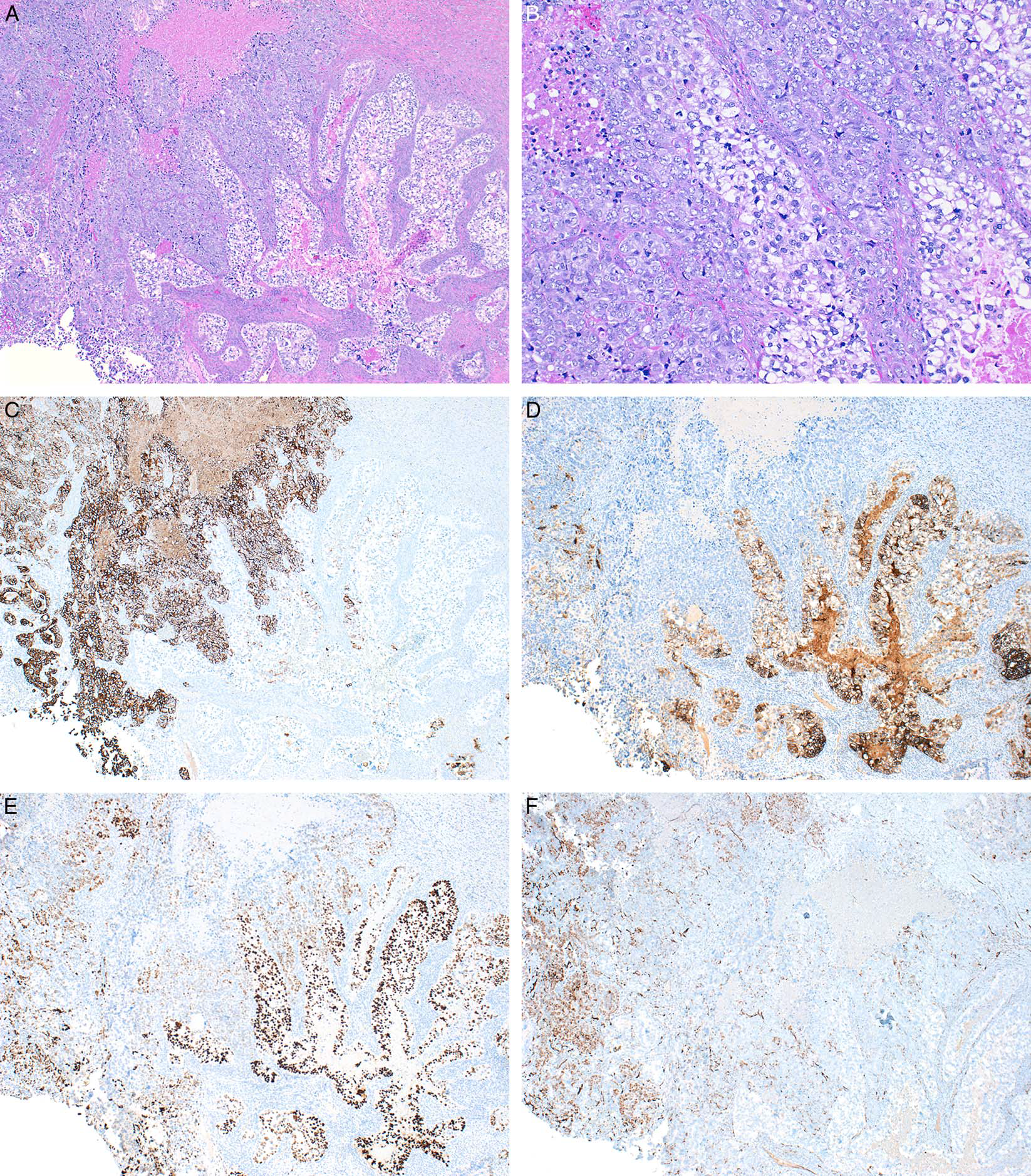 读文献,学病理-40岁以上女性恶性肿瘤中的卵黄囊瘤分化 读文献,学病理-40岁以上女性恶性肿瘤中的卵黄囊瘤分化