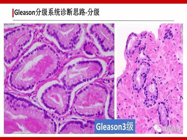前列腺癌Gleason分级系统的前世今生