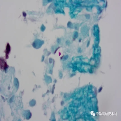 如何避免抗酸染色假阳性