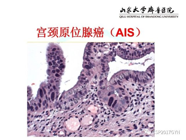 中华病理学会基层培训遵义站讲座（四）——宫颈腺癌的诊断及新分型