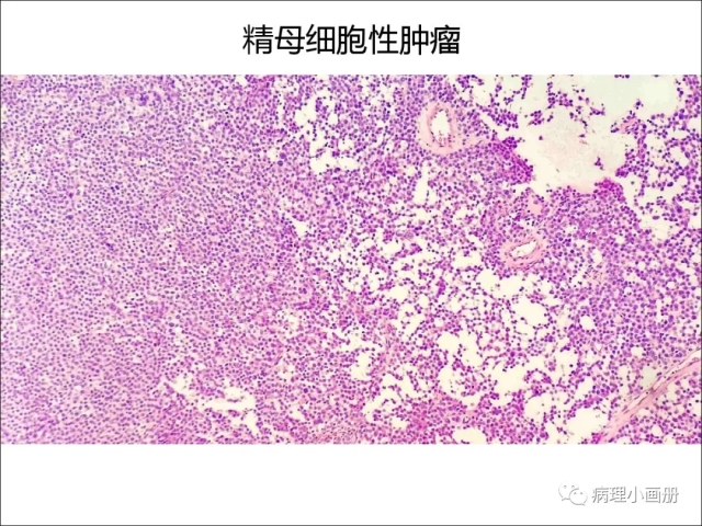 泌尿病理--精原细胞瘤VS精母细胞瘤
