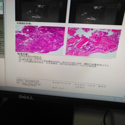 舌根肿物切除病理结果，省大会诊仍然不确诊，请大家帮帮忙
