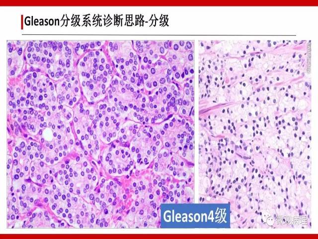 前列腺癌Gleason分级系统的前世今生