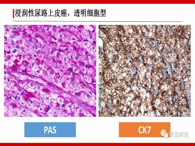 泌尿课程/浸润性尿路上皮癌病理学类型
