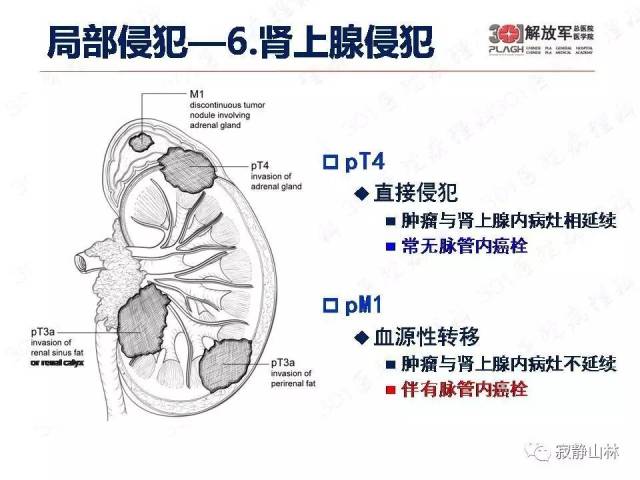 泌尿系统常见肿瘤标本病理报告规范