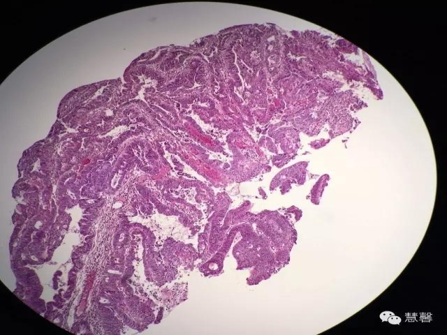 结、直肠管绒毛状腺瘤-高级别病变诊断等相关问题2（悄悄分享、孔祥田(Max)*Roswell*老师讲解）