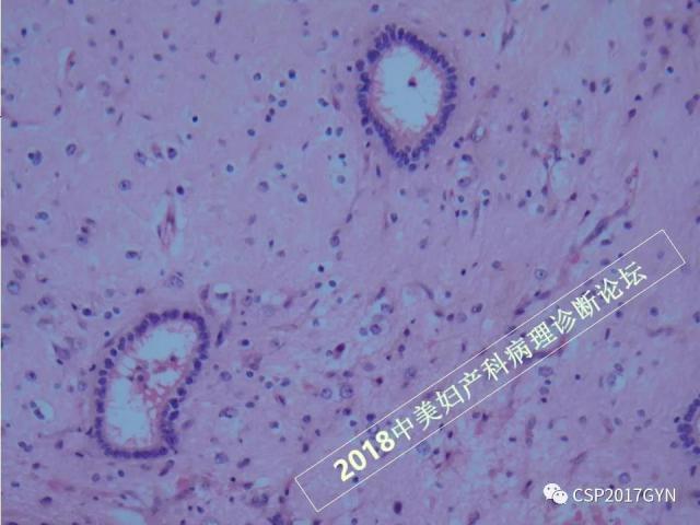 卵巢畸胎瘤诊断难点