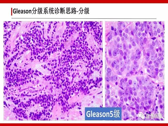 前列腺癌Gleason分级系统的前世今生