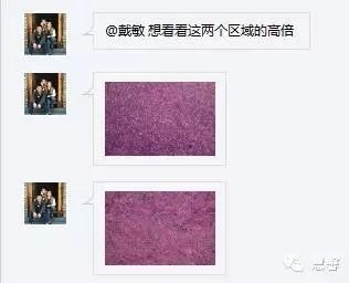 低分化支持－间质细胞瘤（ 戴敏病例分享，群友讨论，刘从容老师讲解）