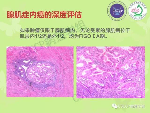 宫颈与子宫病变病理标本取材