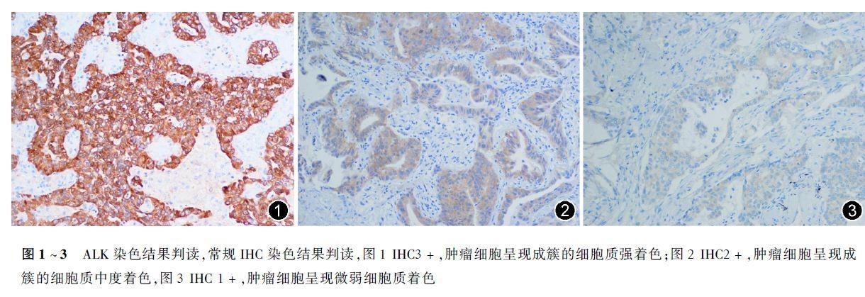 常规免疫组织化学初筛ALK阳性 非小细胞肺癌专家共识——摘自（中华病理学杂志2015年第7期）