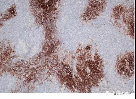 成熟T细胞淋巴瘤(11)——AITL